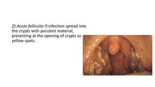 2).Acute follicular infection spread into
the crypts with purulent material,
presenting at the opening of crypts as
yellow spots.
 