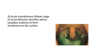 3).Acute membranous follows stage
of acute follicular tonsillitis where
exudates coalesce to form
membrane on the surface
 
