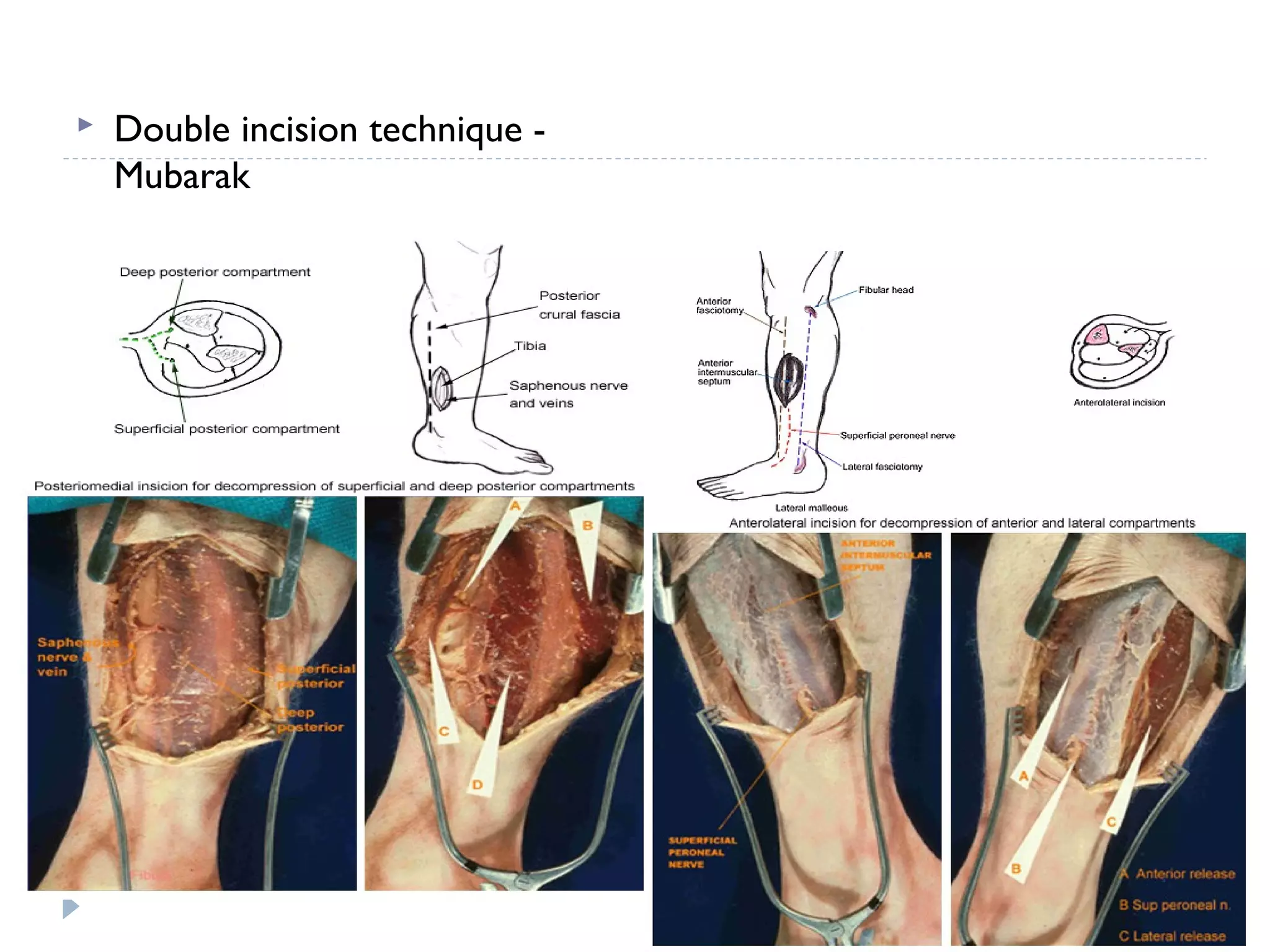  Double incision technique -
Mubarak
 