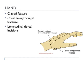 Dorsal Racket Incision Acute compartment syndrome | PPT