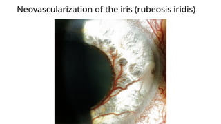 Acute Complication of diabetes mellitus is presentation for third year ...