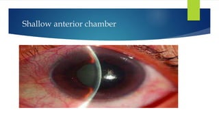 Shallow anterior chamber
 