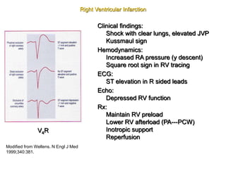Preload Effected Rv Infarct Acute coronary.ppt.Acute Coronary Syndrome | PPT