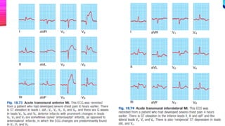 Acute Coronary Syndrome (ACS), Medicine | PPTX