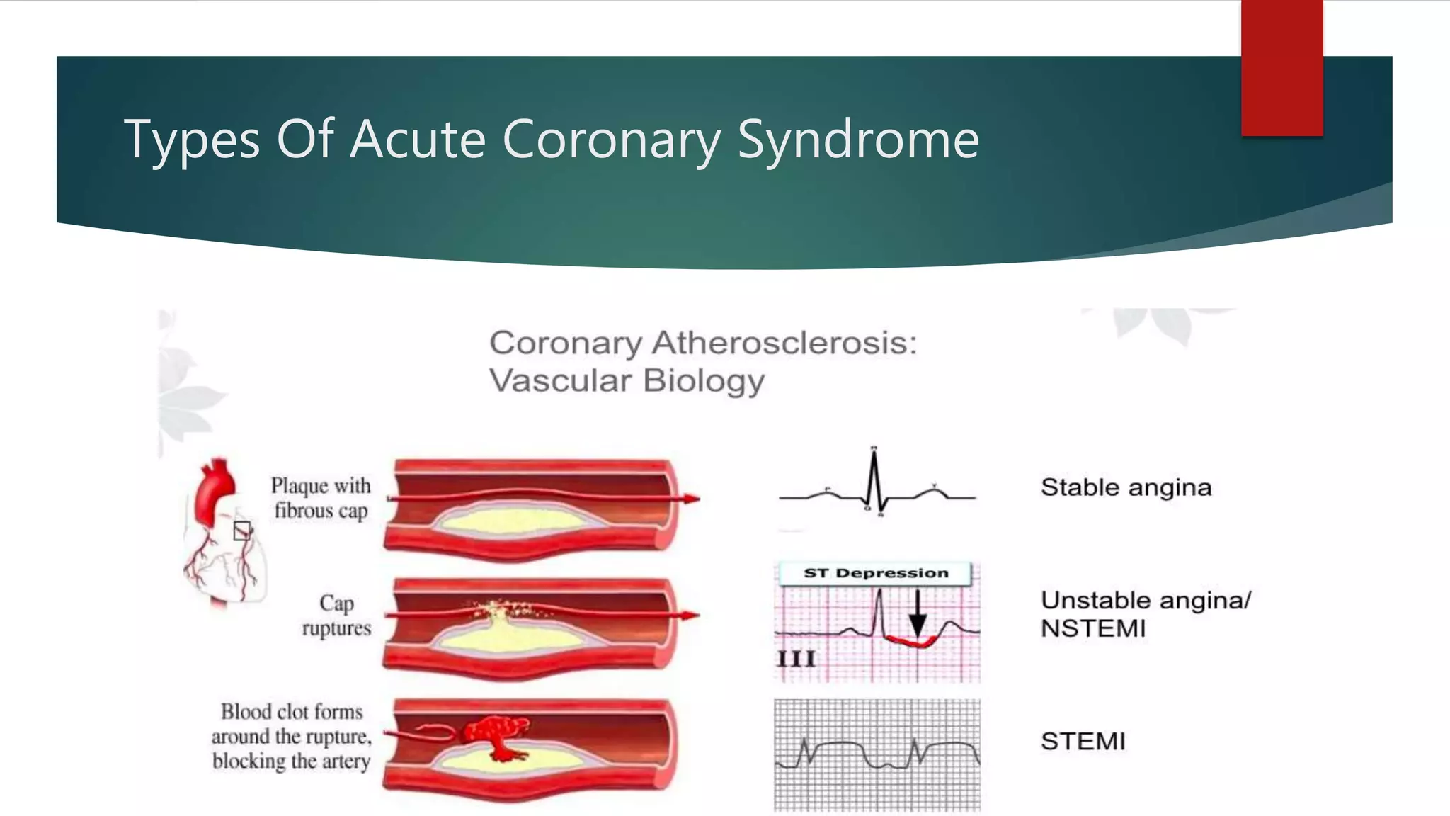 Acute coronary syndrome | PPTX