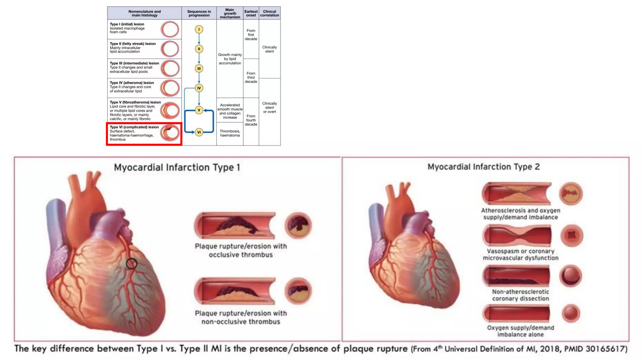 Acute Coronary Syndrome | PDF