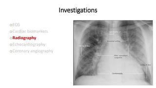 Investigations
oECG
oCardiac biomarkers
oRadiography
oEchocardiography
oCoronary angiography
 