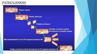 Acute coronary syndrome | PPTX