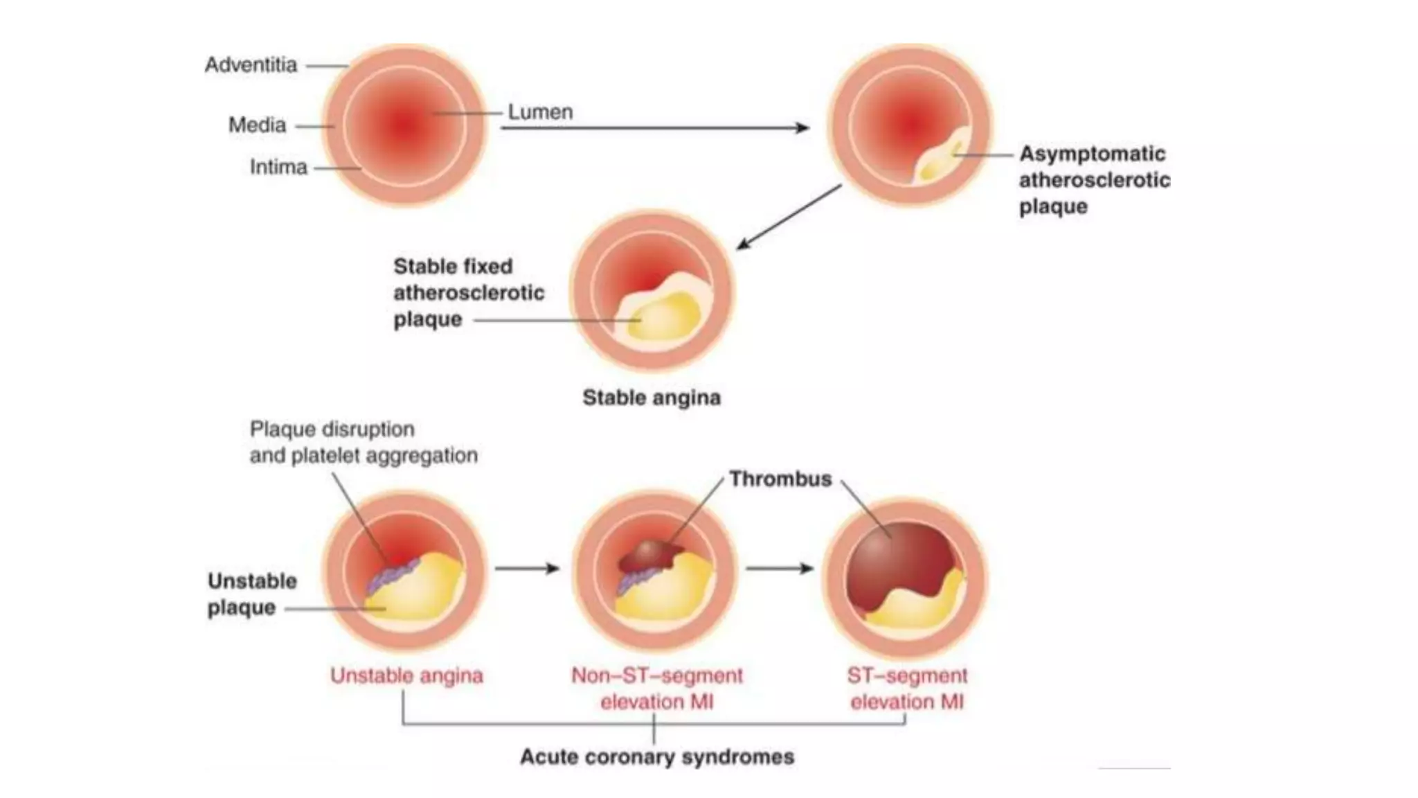 Acute coronary syndrome (acs) | PPTX