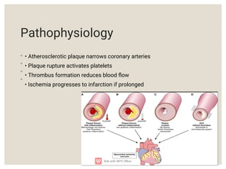 Acute Coronary Syndrome Myocardial Infarction and Angina.pdf