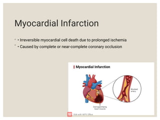Acute Coronary Syndrome Myocardial Infarction and Angina.pdf