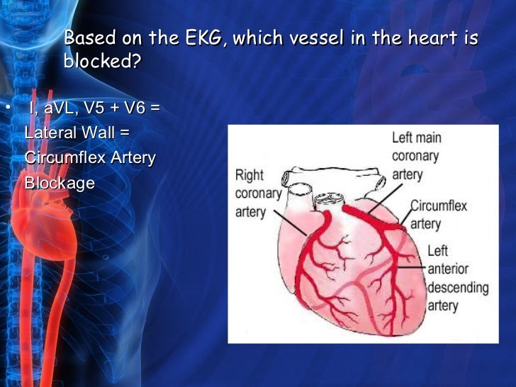 Acute coronary syndrome presentation with bivalirudin