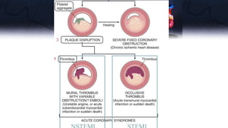 Acute coronary syndrome.pptx
