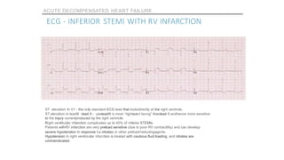 Preload Effected Rv Infarct An approach to Acute Decompensated Heart failure | PPTX