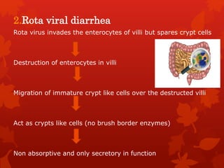 2.Rota viral diarrhea
Rota virus invades the enterocytes of villi but spares crypt cells
Destruction of enterocytes in villi
Migration of immature crypt like cells over the destructed villi
Act as crypts like cells (no brush border enzymes)
Non absorptive and only secretory in function
 