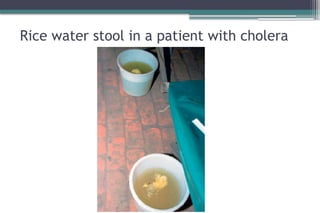 Stool Rice Water acute diarrhea in pedatrics ege old.pptx