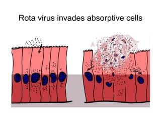 Rota virus invades absorptive cells
 