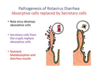 Pathogenesis of Rotavirus Diarrhea
Absorptive cells replaced by Secretary cells
• Rota virus destroys
absorptive cells
• Secretary cells from
the crypts replace
absorptive cells
• Nutrient
Malabsorption and
diarrhea results
 
