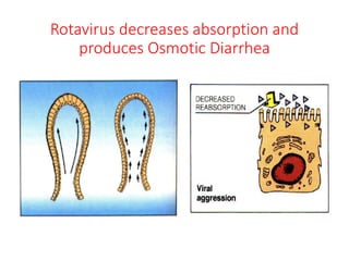 Rotavirus decreases absorption and
produces Osmotic Diarrhea
 
