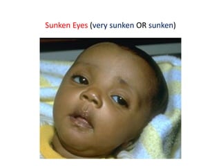 Sunken Eyes (very sunken OR sunken)
 