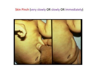Skin Pinch (very slowly OR slowly OR immediately)
 