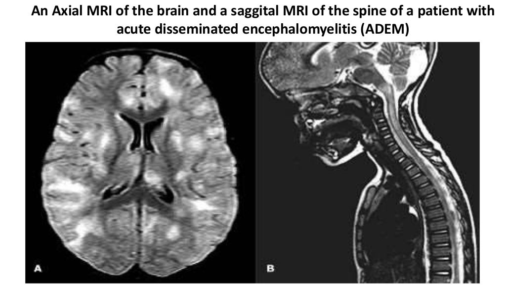 Acute disseminated encephalomyelitis
