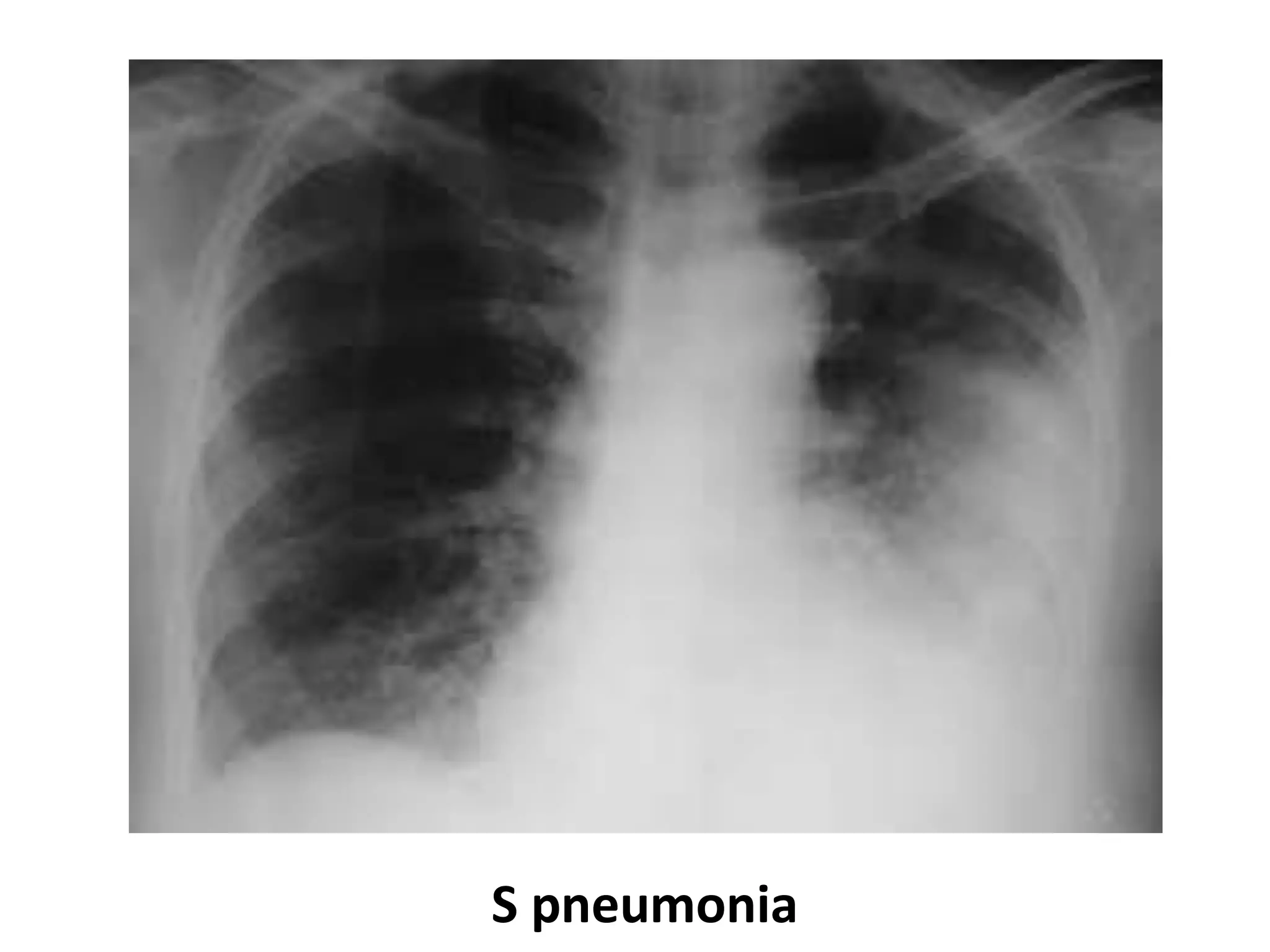 S pneumonia
 