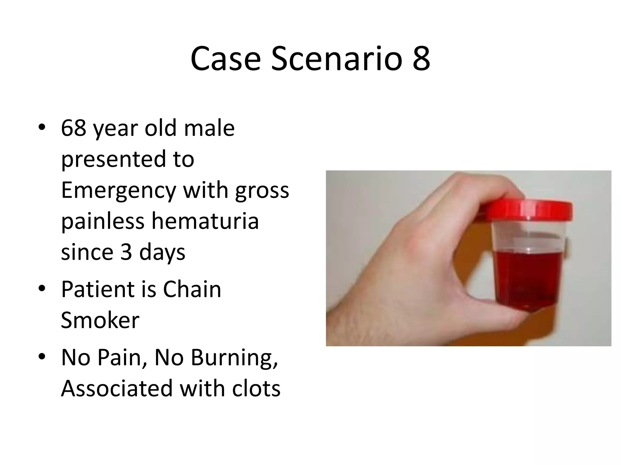 Case Scenario 8
• 68 year old male
presented to
Emergency with gross
painless hematuria
since 3 days
• Patient is Chain
Smoker
• No Pain, No Burning,
Associated with clots
 