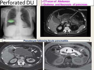 Perforated DU CT-scan of Abdomen
Oedema and Necrosis of pancreas
Pseudocyst following Acute pancreatitis
 