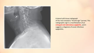 A lateral soft-tissue radiograph
of the neck showed a “thumb sign” (arrow). This
radiographic sign is a manifestation of an
enlarged and edematous epiglottis, and it
suggests a diagnosis of acute infectious
epiglottitis.
 