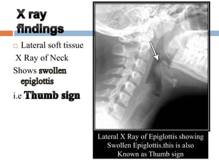  Lateral soft tissue 
X Ray of Neck 
Shows 
i.e 
Lateral X Ray of Epiglottis showing 
Swollen Epiglottis.this is also 
Known as Thumb sign 
 