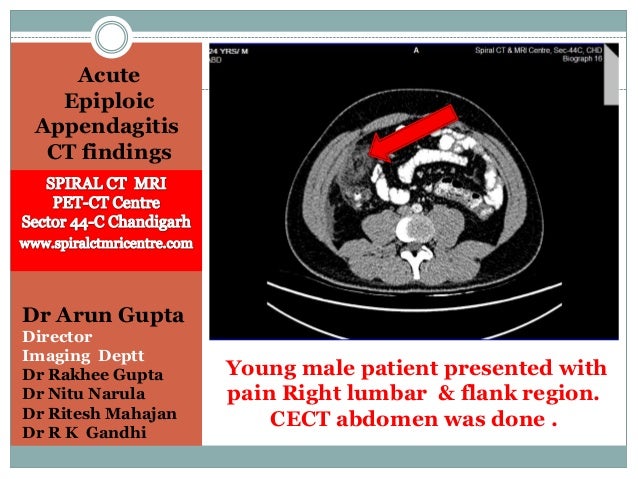 Acute epiploeic appendagitis.pptx2 Acute epiploeic appendagitis.pptx2
