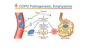 ACUTE EXACERBATION OF CHRONIC OBSTRUCTIVE PULMONARY DISEASE | PPTX