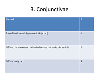 3. Conjunctivae
Normal 0
Some blood vessels hyperaemic (injected) 1
Diffuse,crimson colour; individual vessels not easily discernible 2
Diffuse beefy red 3
 