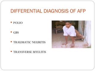 Comprehensive Overview of Acute Flaccid Paralysis and Poliomyelitis ...