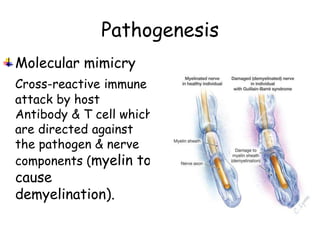 Pathogenesis
Molecular mimicry
Cross-reactive immune
attack by host
Antibody & T cell which
are directed against
the pathogen & nerve
components (myelin to
cause
demyelination).
 
