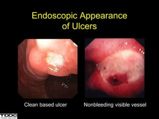 Endoscopic Appearance
of Ulcers
Clean based ulcer Nonbleeding visible vessel
 