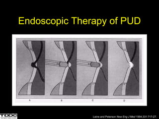 Endoscopic Therapy of PUD
Laine and Peterson New Eng J Med 1994;331:717-27.
 