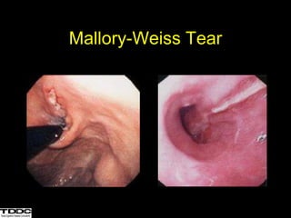 Mallory-Weiss Tear
 