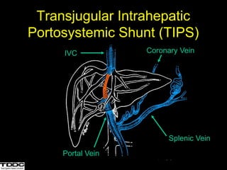 Transjugular Intrahepatic
Portosystemic Shunt (TIPS)
IVC
Portal Vein
Splenic Vein
Coronary Vein
 