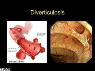 Diverticulosis
 
