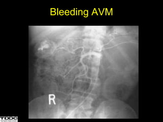 Bleeding AVM
 