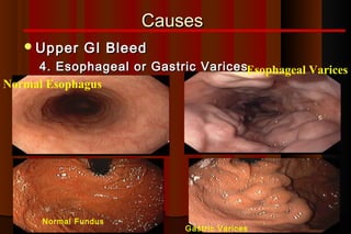 Causes
    Upper    GI Bleed
     4. Esophageal or Gastric VaricesEsophageal Varices
Normal Esophagus




      Normal Fundus
                             Gastric Varices
 