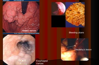 Gastric varices
                           Bleeding ulcers




                                Dieulafoy’s lesion




              Esophageal
              Varices
 