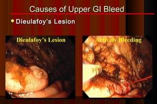Causes of Upper GI Bleed
 Dieulafoy’s   Lesion

 Dieulafoy’s Lesion      Actively Bleeding
 