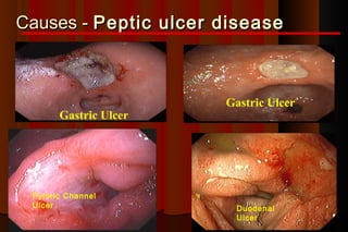 Causes - Peptic ulcer disease



                       Gastric Ulcer
       Gastric Ulcer




 Pyloric Channel
 Ulcer                  Duodenal
                        Ulcer
 