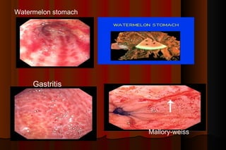 Watermelon stomach




     Gastritis




                     Mallory-weiss
 