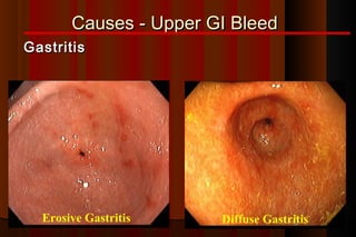 Causes - Upper GI Bleed
Gastritis




  Erosive Gastritis    Diffuse Gastritis
 