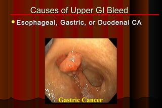 Causes of Upper GI Bleed
 Esophageal,   Gastric, or Duodenal CA




                Gastric Cancer
 