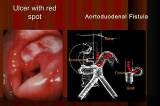 Ulcer with red
    spot                Aortoduodenal Fistula


                              Aorta




                 Duodenum


                                      Fistula



                                                Graft
 